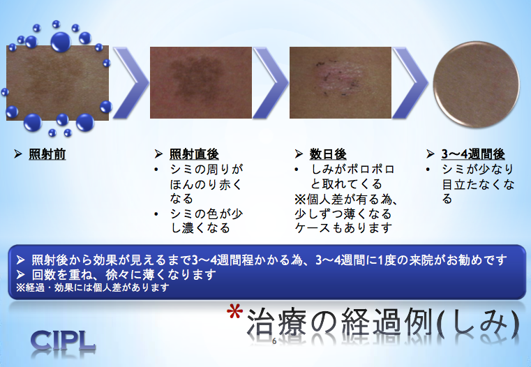 治療の経過例(しみ)